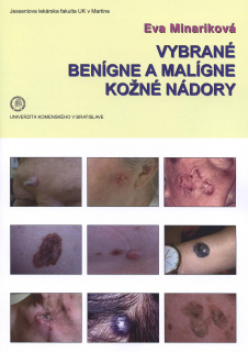 Vybrané benígne a malígne kožné nádory