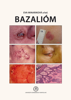 Bazalióm – Sprievodca diagnostikou a liečbou bazaliómu